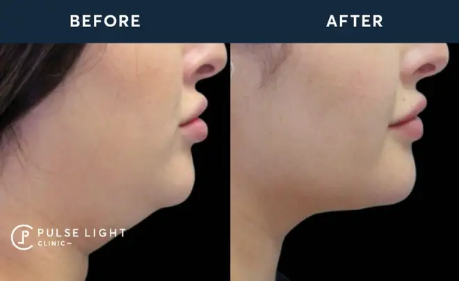 The double chin removal procedure works in just one treatment!