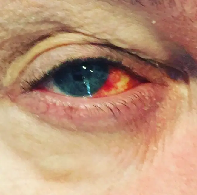 Eamonn Holmes appeared to have a burst vessel in his eye