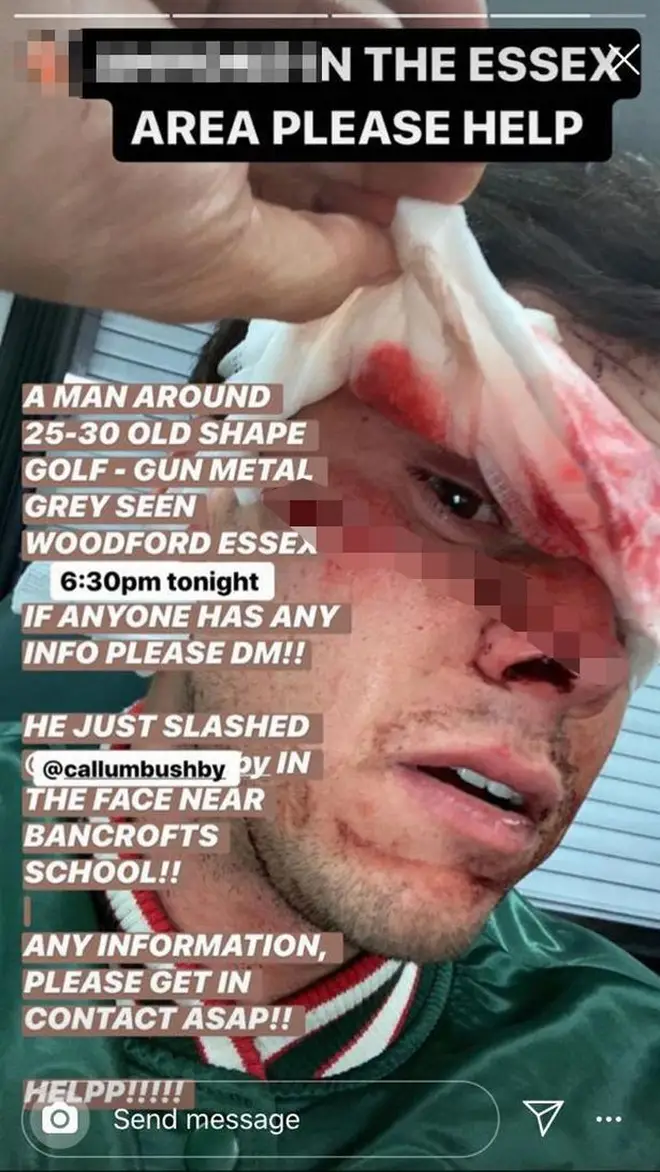 The TOWIE shared a photo of Callum’s injured face on Instagram.