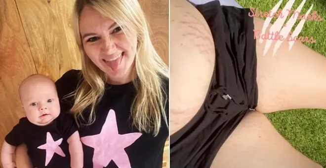 Melissa Suffield has revealed her stretch marks on Instagram