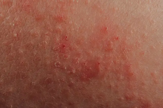 Scientists want rashes to be added to the list