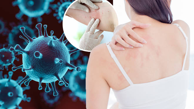Experts want skin rashes to be added to the NHS' official list of COVID-19 symptoms