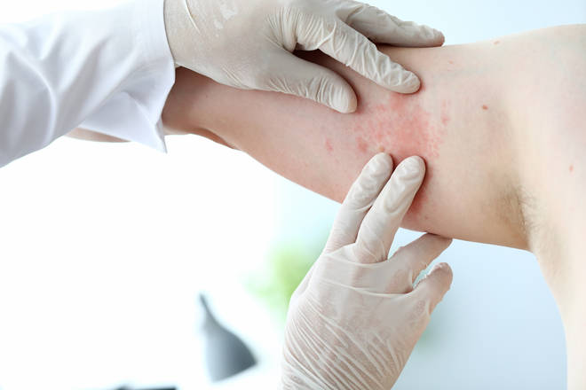 Research found that just under nine per cent of people who tested positive for coronavirus reported having skin rashes