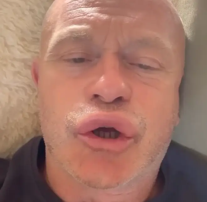 Ross Kemp was stung by three or four bees
