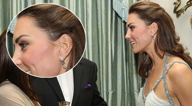Kate Middleton has a scar from a 'childhood operation' visible on her head