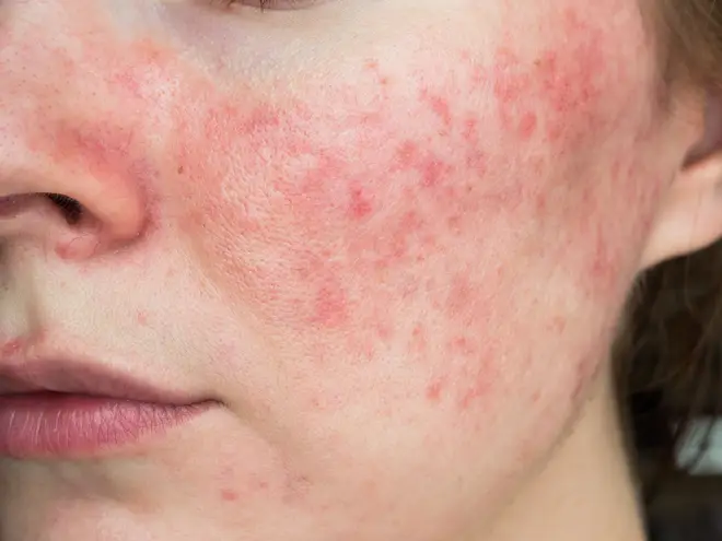 It is unknown what causes rosacea in adults