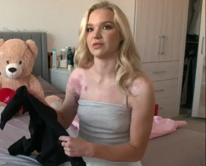 Abbie suffered burns while filming a YouTube tutorial
