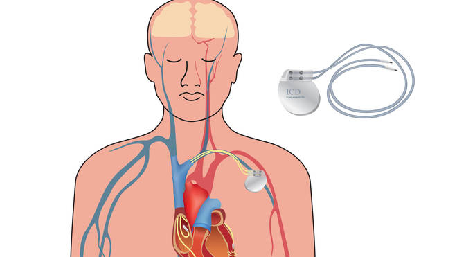 The device sends electrical pulses to regulate an abnormal heart rhythm
