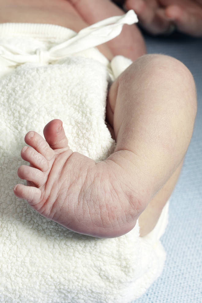 Club foot, also called talipes, is a condition where a baby is born with a foot or feet that turn in and under