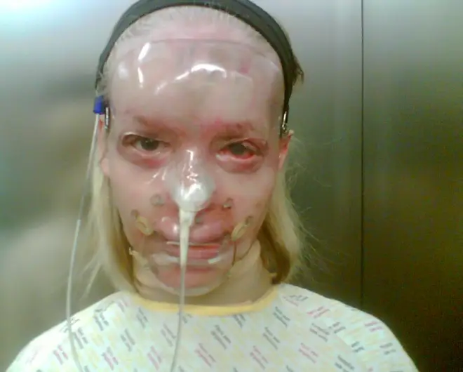 Katie shared this pic from nine years ago just after the acid attack