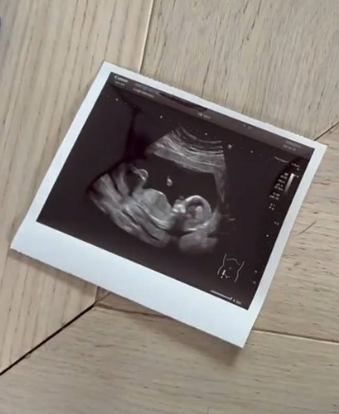 Jorgie Porter shared a picture of her sonogram