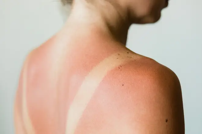People are being told to check their suncream for an expiry date to avoid skin damage