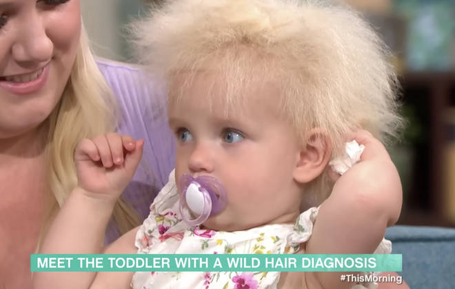 Toddler's rare uncombable hair syndrome causes locks to grow outwards -  Heart