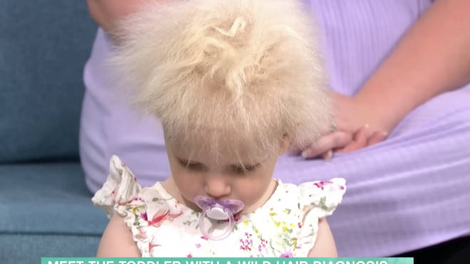 Toddler's rare uncombable hair syndrome causes locks to grow outwards -  Heart