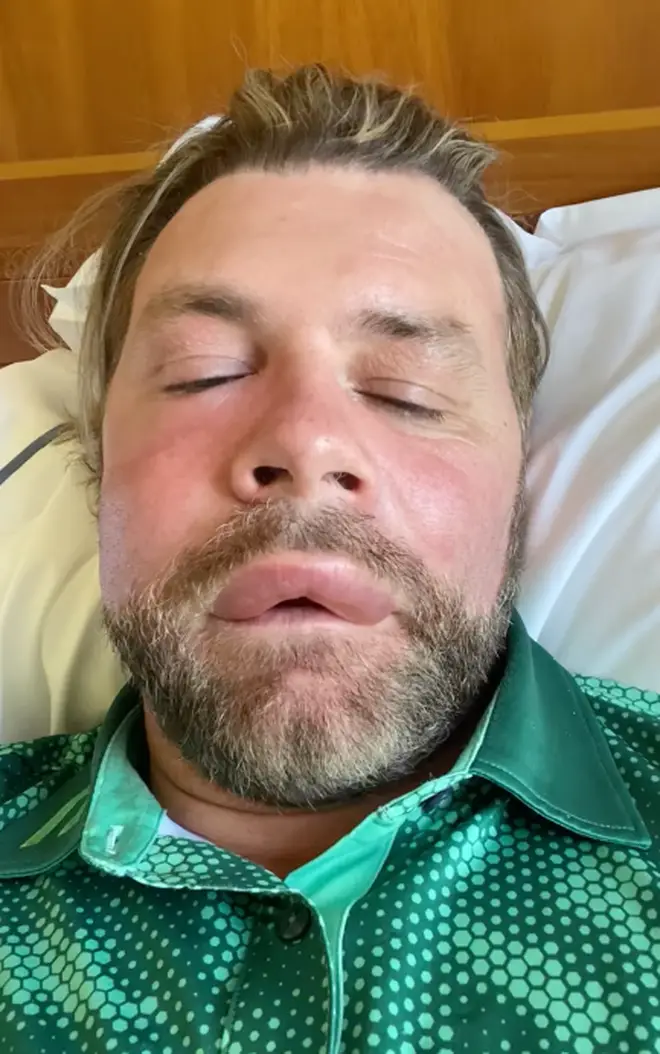 Brian McFadden's face swelled up after a bee sting caused him to have an allergic reaction