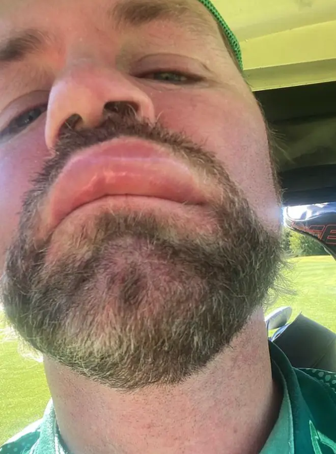 Brian McFadden was playing golf when the bee sting caused his lips to swell up