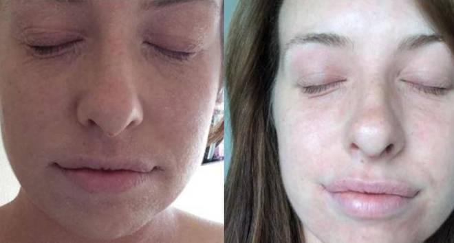A woman has praised the simple skincare routine with soothing her eczema in a matter of days