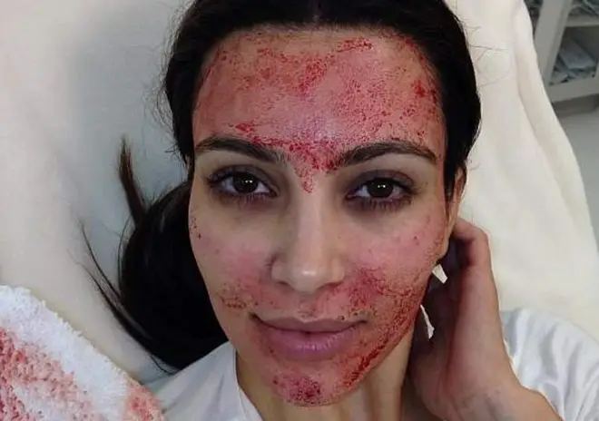 Kim Kardashian made the 'Vampire Facial' popular