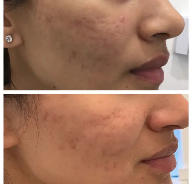 This picture shows before and after results from a microneedling procedure at Regents Park Aesthetics