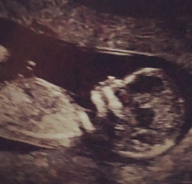 Stacey Solomon shared a picture of her baby scan