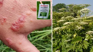 Warning issued over poisonous giant hogweed after burns leave man with scarring
