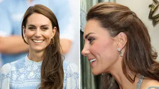 Kate Middleton has a scar on the left side of her head