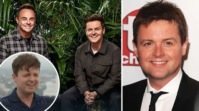 Has Declan Donnelly had a hair transplant?