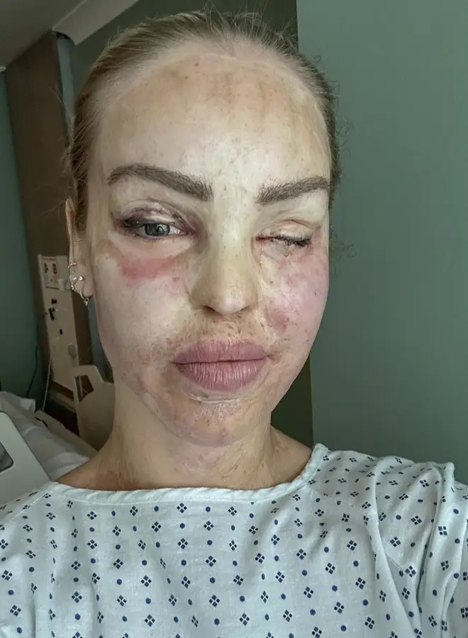 Katie Piper has documented her eye surgery journey