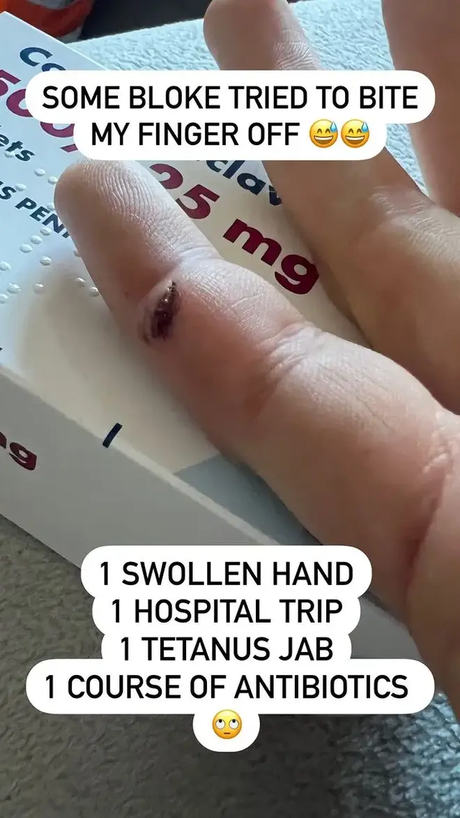 Luke posted a photo of his injured finger on social media.