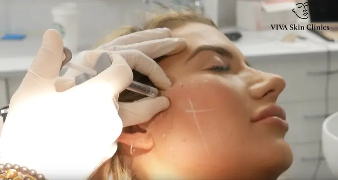 Cheek filler is placed in multiple 'dots' across the cheekbone