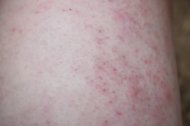 Sweat rash can be identified by small, raised, red bumps