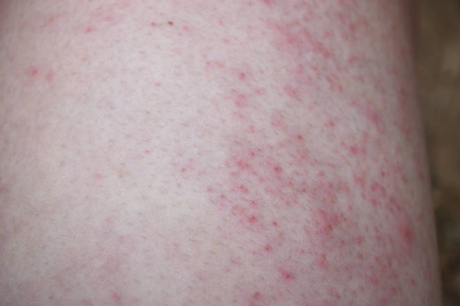Sweat rash can be identified by small, raised, red bumps