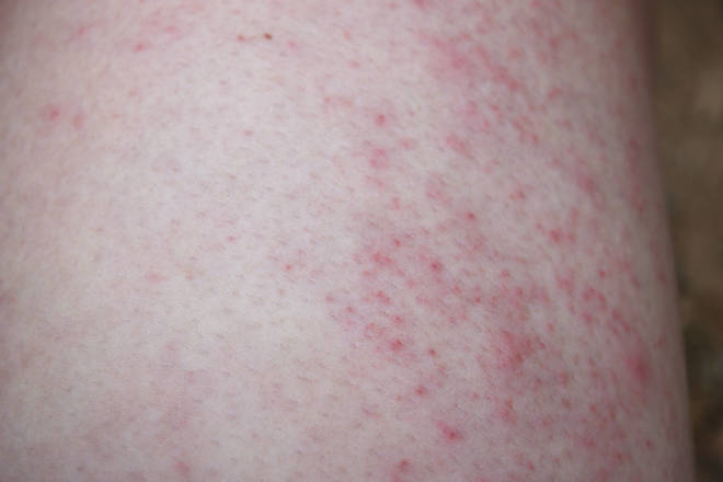 Heat Rash Legs