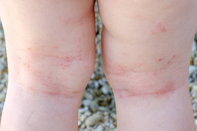 Sweat rash can appear anywhere on the body, but is common on the legs and other areas that get damp