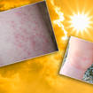 Hot weather can cause unsightly and painful sweatrash