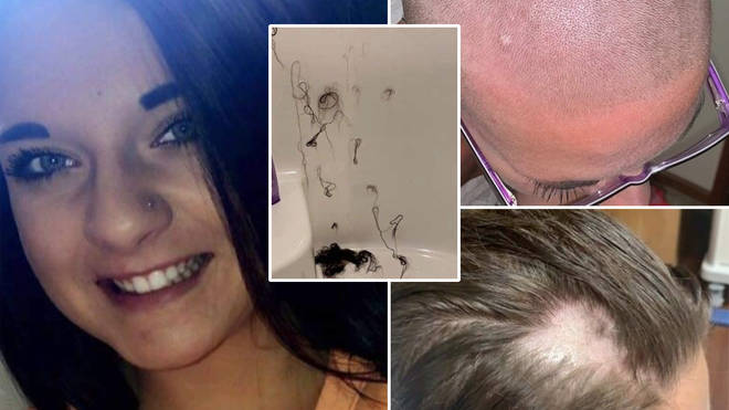 Woman 21 Devastated As Hair Falls Out After Using Tampered