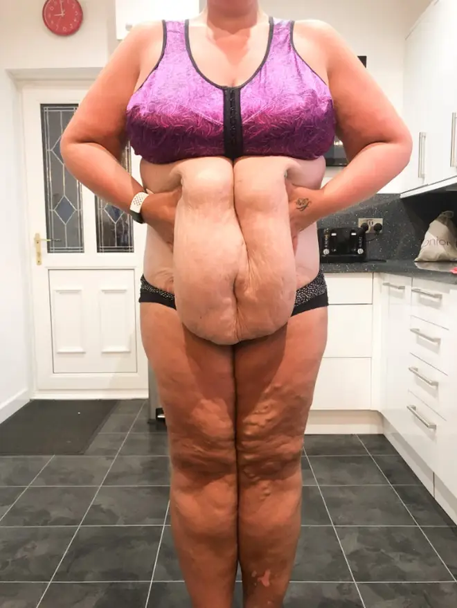 Steff has been left with 15lbs of excess skin following the surgery