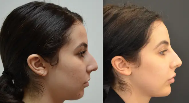 This lady's profile was transformed after filler in her chin and nose