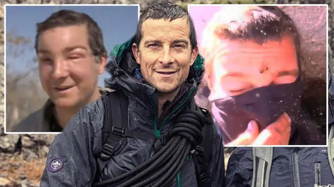 Bear Grylls has suffered another serious reaction to a bee sting