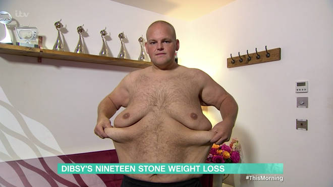 Dibsy revealed he has four stone of excess skin