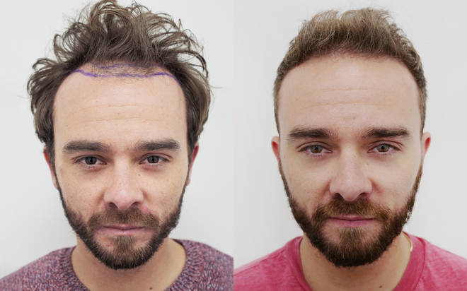 The difference in Jack's hairline is clear to see