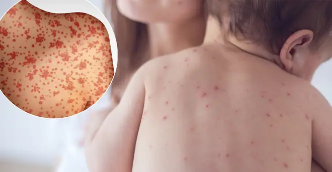 There has been a suspected measles outbreak in Essex