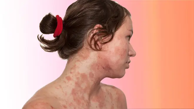 Eczema is incredibly painful - and sufferers might have been given misleading advice