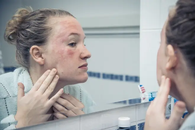 Eczema is a painful and complicated condition