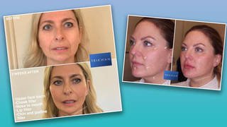 These women rejuvenated their look with liquid face lifts