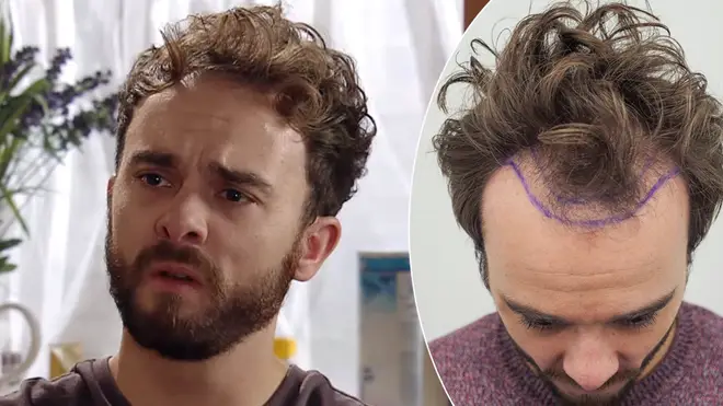 Jack Shepherd has reportedly been fined for plugging his hair transplant