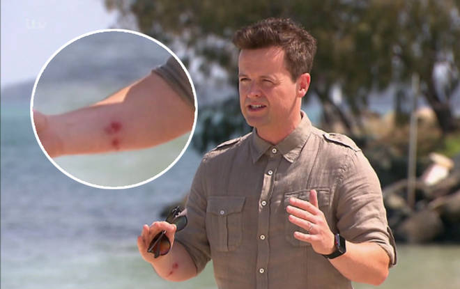 Dec suffered a nasty burn and fans were seriously concerned