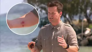 Dec suffered a nasty burn and fans were seriously concerned
